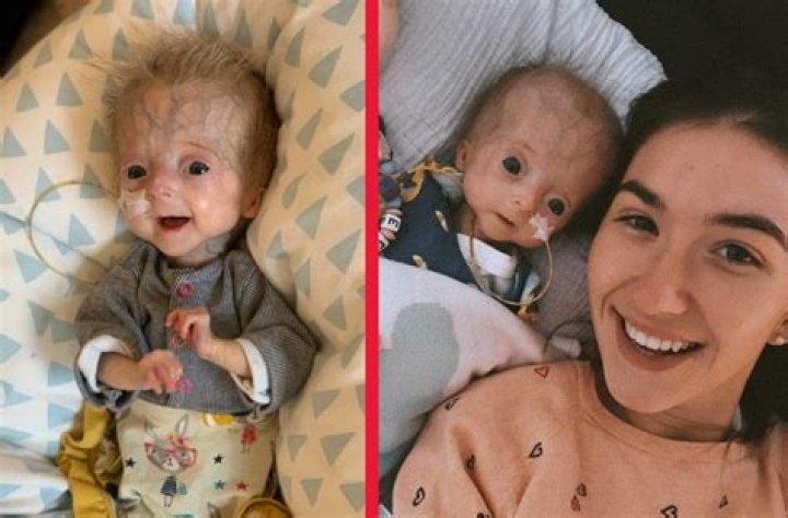 Baby Eline Leonie Progeria Disease