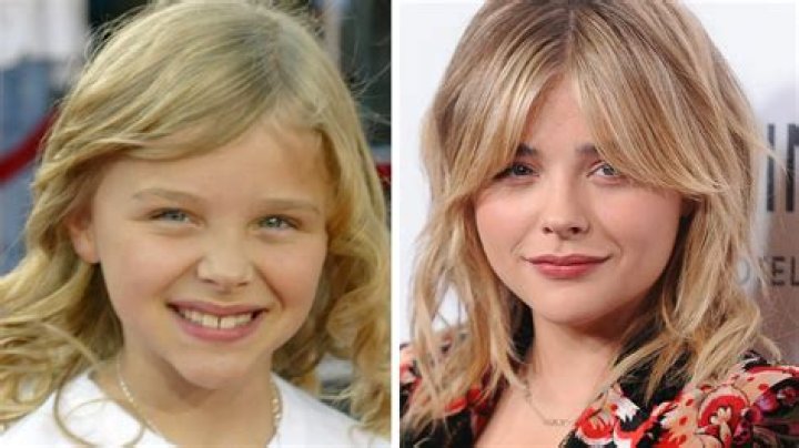 Chloe Grace Moretz's Plastic Surgery Journey: Unveiling Her Transformation