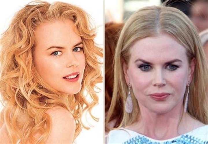 Unveiling Nicole Kidman's Transformation: A Look Back At Her Appearance Before Surgery