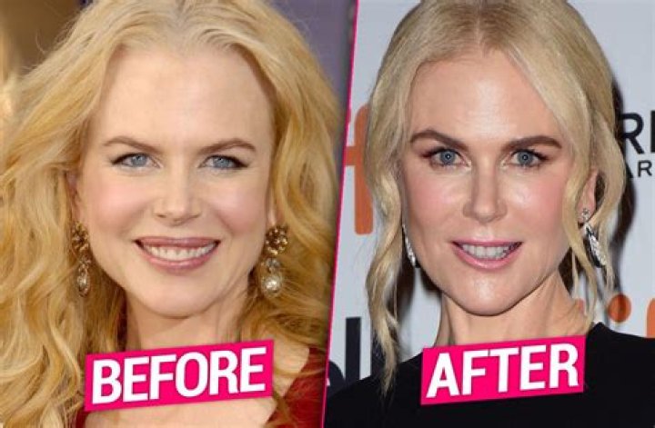 The Truth About Nicole Kidman's Alleged Facelift