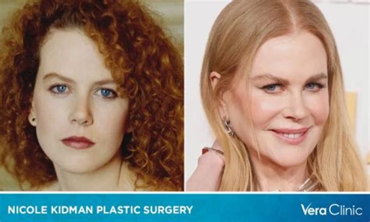 Nicole Kidman's Plastic Surgery Journey: Before And After