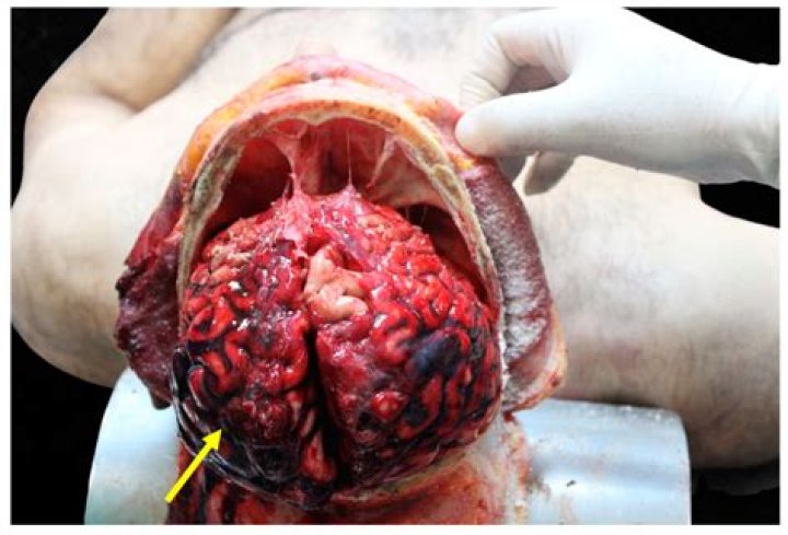 Unveiling Tarrare's Extraordinary Organs: A Post-Mortem Examination